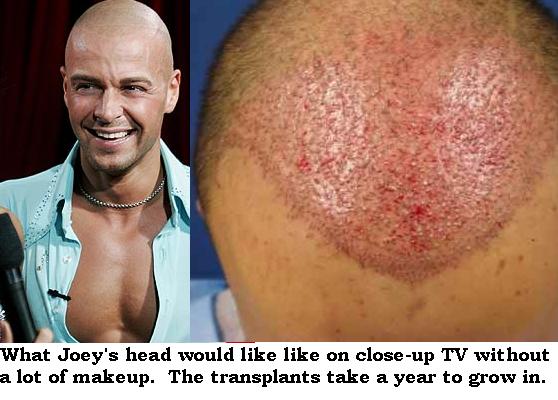 Insiders agree: “Joey Lawrence is getting more hair transplants.”