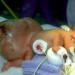 Facebook Photo of Newborn With Giant Tumor — CLICK FOR DOLLARS – HOAX & FAKE