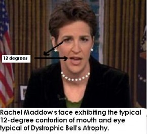 maddow palsy suffering nerve thedamienzone